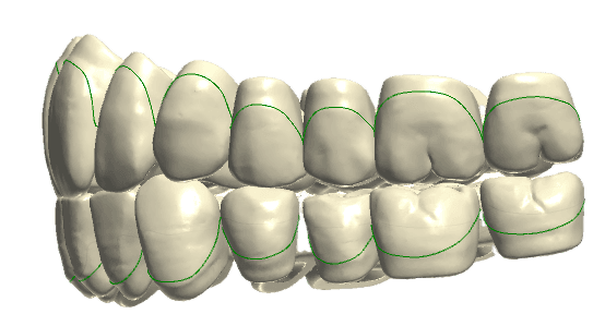 Prognathic(<-1mm) teeth shape