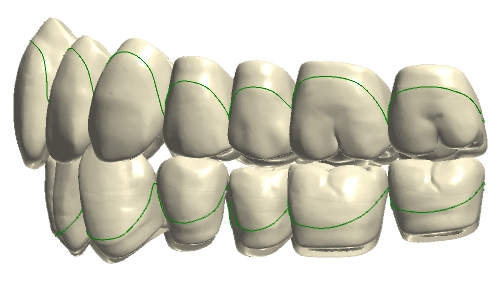 Retrognathic(>3mm) teeth shape